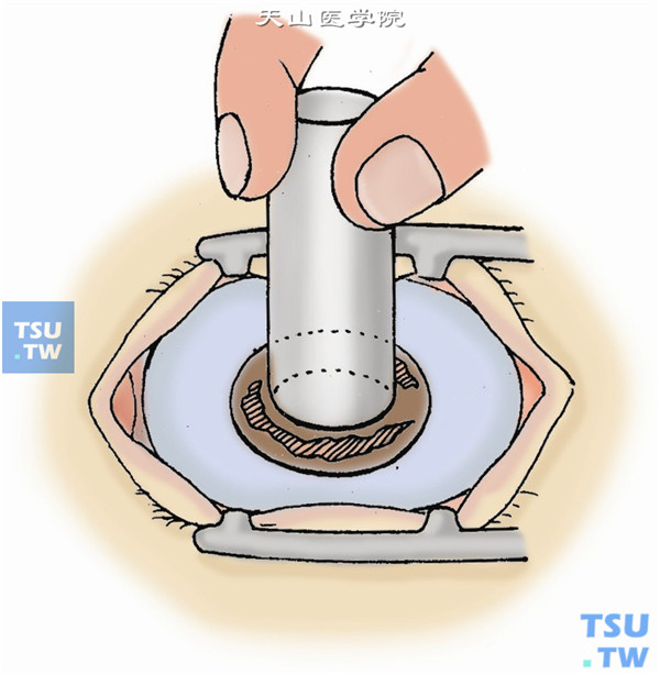 用7mm或7.5mm环钻在患眼角膜中央做0.3mm深的环钻划