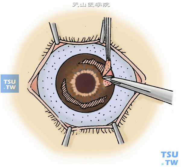 用单齿镊提起环钻切口外缘的角膜组织，用刀片做环状板层角膜剖切