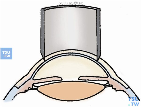 用移植床划界的同一环钻在上述已经完成密闭式剖切的供眼角膜移植片上，钻去中央角膜组织，形成指环形板层移植片