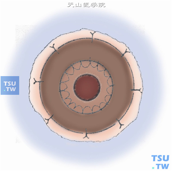 移植片套入移植床，用10-0尼龙线缝合固定于术眼巩膜侧