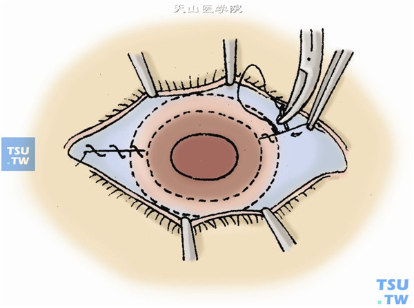 用6-0可吸收线做间断缝合，将后徙的球结膜复位，遮盖移植片的巩膜环