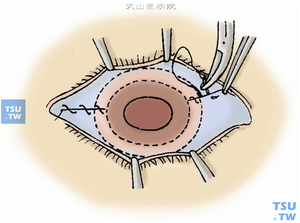 结膜遮盖术图片