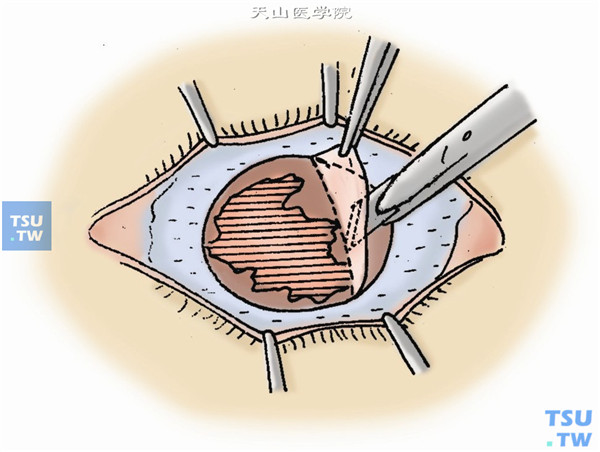 沿角膜缘做全周角膜缘板层切口，由正常角膜侧做全角膜板层剖切，深度以去除病变角膜为度