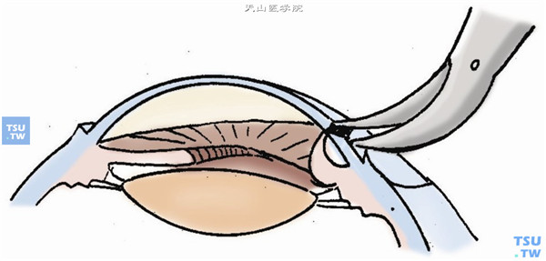 将脱出的虹膜做节段性切除