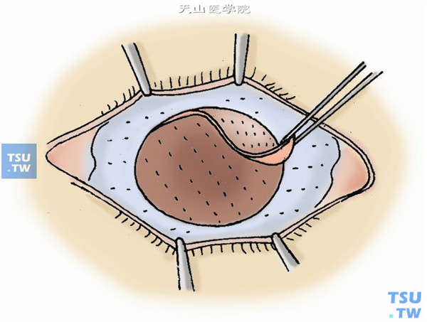 在已制取的全板层角膜移植片的供眼上，切取新月形的带内皮的板层角膜移植片