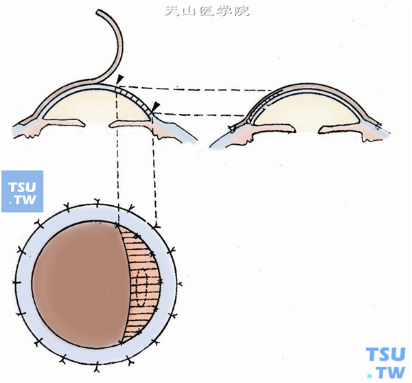用尼龙线在角膜缘间断缝合