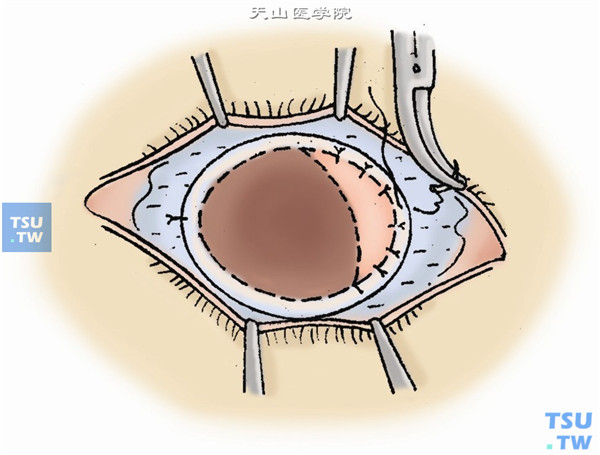 再将带有5mm宽板层巩膜环的全角膜板层移植片移植于植床上。将移植片的全周巩膜间断缝合固定于术眼的表层巩膜，球结膜复位同前
