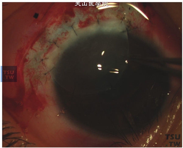 移植同形、大小相等的带板层巩膜环的移植片，角膜侧用10-0尼龙线做连续缝合，巩膜侧做间断缝合，移植片的角膜缘必须与术眼角膜缘准确重叠对合（移植片的环钻口径比移植床大0.5mm（图7））