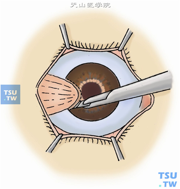 复发性胬肉的板层角膜移植术操作及注意事项