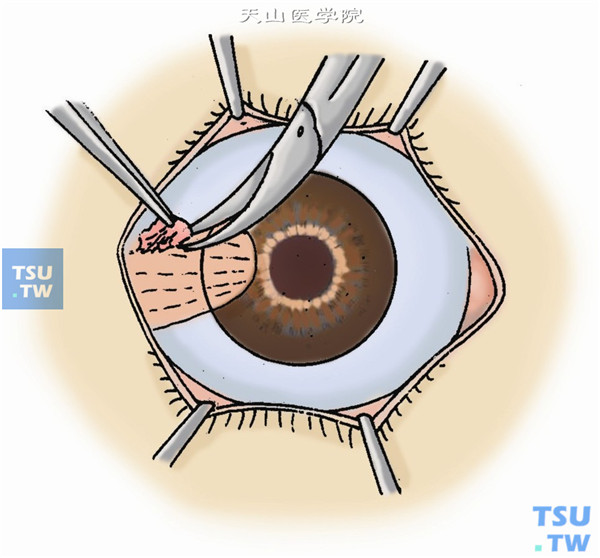 先按常规切除胬肉头、颈及体部，并分离切除胬肉体部球结膜下的增生组织，使眼球运动自如，注意勿损伤眼外肌