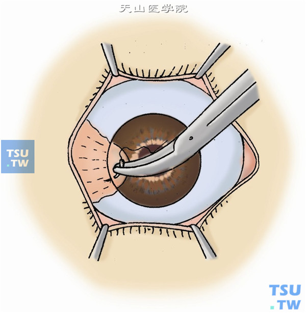 移植同形、同厚、同大小的板层角膜组织，角膜侧用10-0尼龙线做连续缝合，巩膜侧做间断缝合