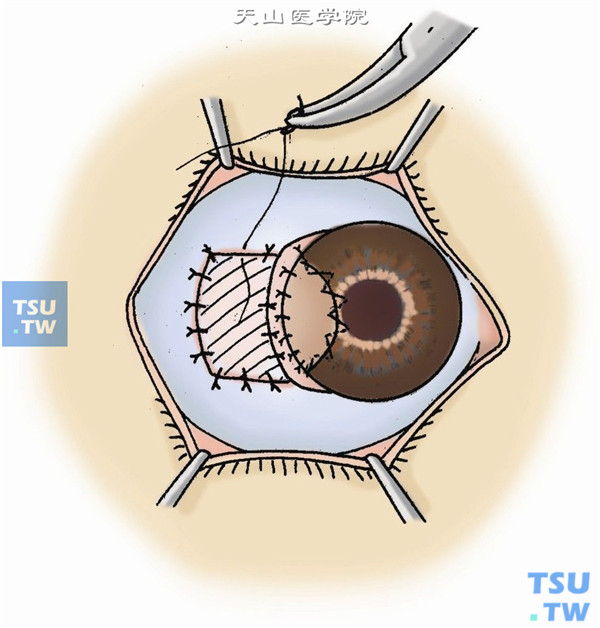 巩膜暴露区可用游离的结膜瓣或羊膜植片覆盖，10-0尼龙线间断缝合固定。球结膜下注射妥布霉素2万U和地塞米松2.5mg，术眼加压包扎