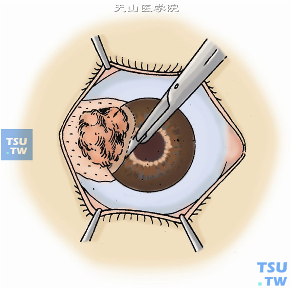 在角膜肿物外1mm处的正常角膜做0.3mm深度的弧形板层角膜切口，肿物外2mm处球结膜亦剪开