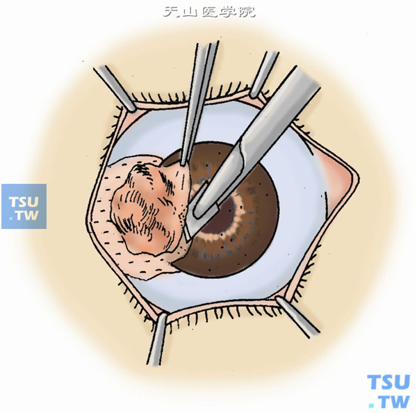 用刀片沿角膜切口进行板层剖切，深度以没有肿瘤浑浊组织残留为准