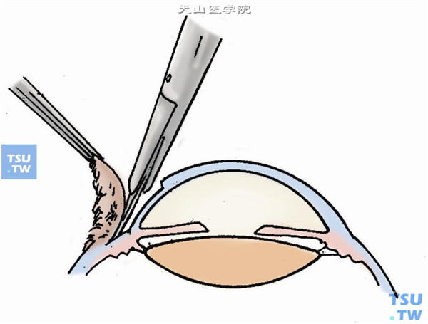 当剖切越过角膜缘时，即做表层巩膜板层切除，使肿物完整地连同角巩膜组织被切除