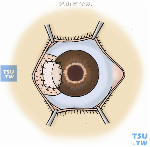 当角巩膜板层切除完成后，再用刀片切除一薄层肿物所在部位的角巩膜组织，送病理检查，以证实有无癌细胞残留。在供眼上切取与移植床同形、同大小的角巩膜板层角膜移植片。将其与移植床相对合，角膜侧用10-0尼龙线连续缝合，巩膜侧间断缝合