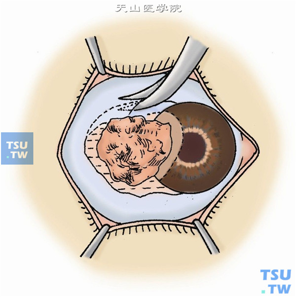 沿角膜缘剪开球结膜，分离病灶区球结膜至越过巩膜坏死溃疡灶以外，清楚显示正常巩膜境界