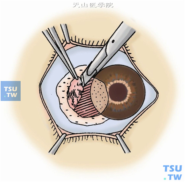 显微镜下板层剖切去除角膜坏死组织