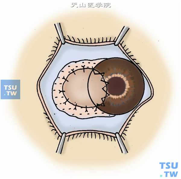 在供眼眼球上，剖切同形、大小相等的角巩膜板层移植片。将角巩膜植片置于移植床上，角膜侧用10-0的尼龙线进行连续缝合，巩膜侧做间断缝合