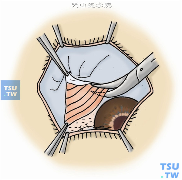 为防止巩膜瓣坏死，由邻近球结膜下分离宽大的眼球筋膜，前徙遮盖巩膜瓣