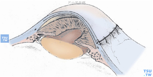人工角膜移植手术操作及注意事项