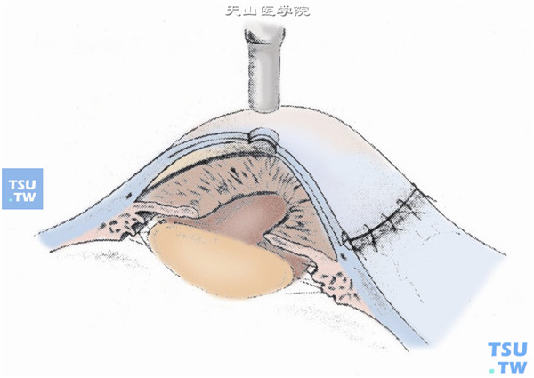 小于人工角膜光学区直径0.5mm的环钻在角膜的中央作一植孔，以保证植入物与角膜组织的紧密结合