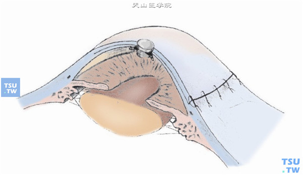 用10-0尼龙线经周边角膜基质、人工角膜周边部作间断缝合，注意不能穿透角膜，线结埋入角膜基质层