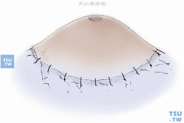 刮去角膜上皮，沿角膜缘作环形球结膜切开，分离结膜使之游离，将结膜覆盖于角膜及人工角膜的表面并用6-0可吸收缝线间断缝合结膜。同时作睑缘缝合