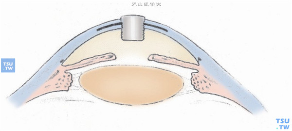 人工眼角膜植入后示意图