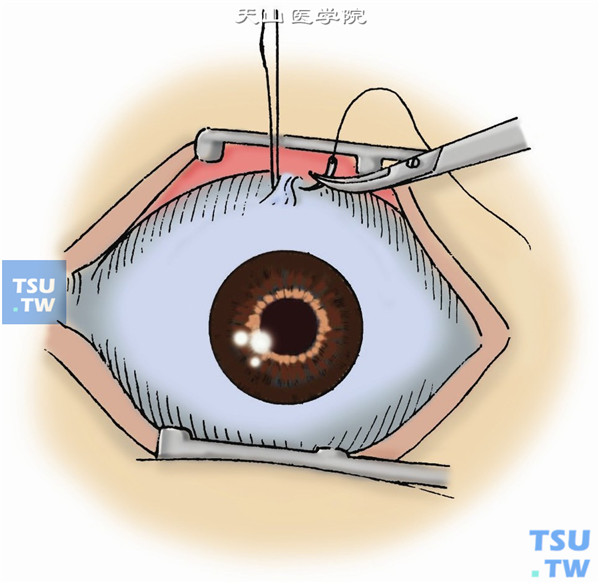 缝下直肌牵引线，用有钩镊夹住下直肌止端，将带5-0丝线的圆针经结膜，通过下直肌肌腱，缝合一针作牵引线