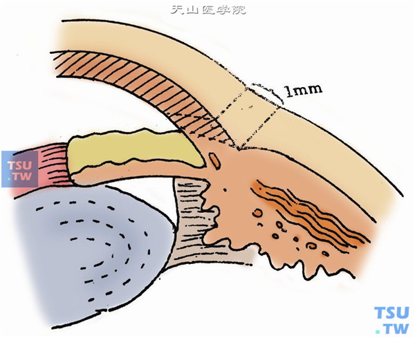 作角膜切口。用固定镊夹持角膜缘外的球结膜及结膜下组织，以加强固定眼球。在下方偏颞侧角膜缘内距角巩膜缘1mm，或在6点钟处，用剃须刀小片或角膜刀，斜行切开角膜全层，约2.5～3mm