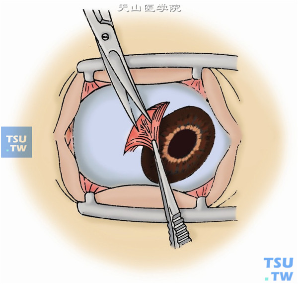 在预定虹膜切除部位（一般选择在鼻下侧）的相对应处，沿角膜缘切开球结膜，约4～5mm长，向后稍作分离，暴露角巩膜缘，烧灼止血