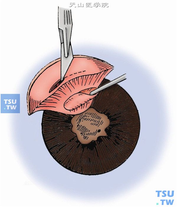 切开角巩膜缘。沿角巩膜缘灰白带交界处切开板层，作一针9-0尼龙线预置缝线。继之慢慢切穿角巩膜缘，长约3～4mm