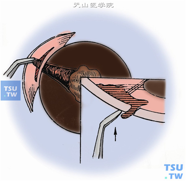 轻轻压迫创口后唇，使虹膜脱出于创口之中或创口之外。如眼压过低，或切口位置不当，虹膜不能脱出时，可将虹膜镊闭合，尖凹面朝上，自创口伸入前房，张开约1～2mm，轻轻夹住虹膜，并引至创口外
