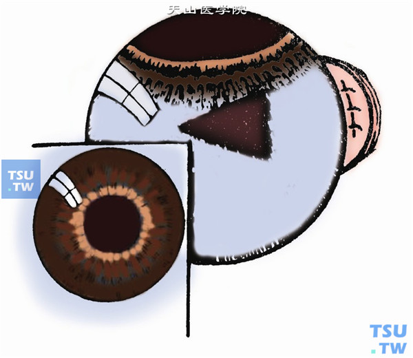 用显微眼内剪伸入前房，沿剌开的虹膜切口上、下端，对虹膜或瞳孔膜分别各作一斜向剪开，将剪下之膜片取出