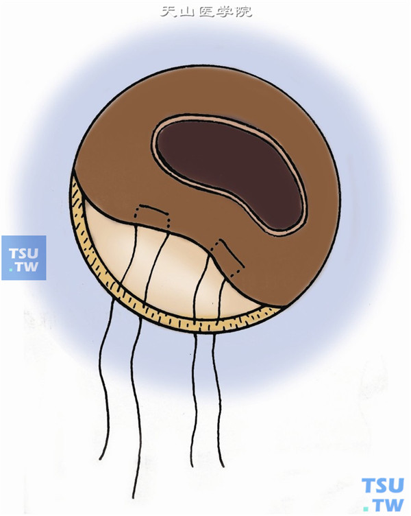 缝合离断的虹膜。用微型钝头眼内平镊，将离断的虹膜根部边缘牵引至角巩膜缘切口处，用带圆针的10-0尼龙线（或10-0聚丙烯线）将其间断或褥式缝合、固定于角巩膜缘切口的后唇上，将瞳孔恢复至居中、圆形