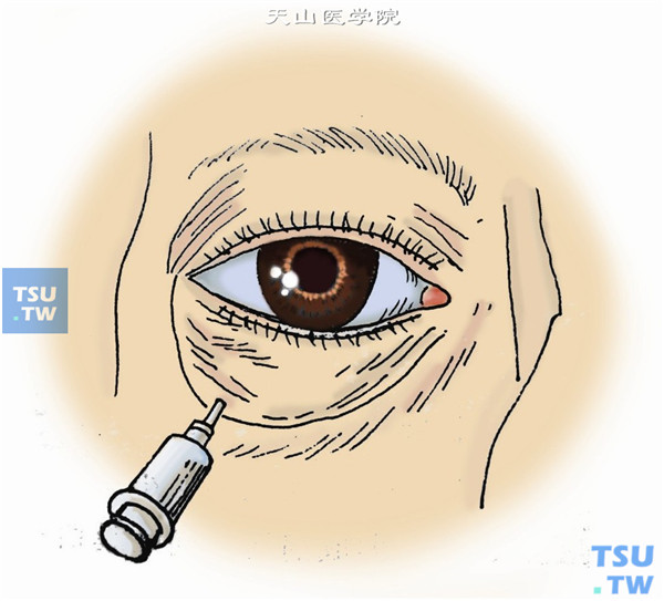 球后麻醉：嘱患者正视位固视，用3.5cm长注射针，从眼眶下缘外侧1/3与内侧2/3交界处垂直皮肤进针，先在皮下注射少量2%利多卡因+0.75%布比卡因混合液，再先针至赤道部附近时改变方向，进针约3cm至眼外肌间隙附近，回抽针筒，确认无回血后，才可注入混合麻醉液2～3ml