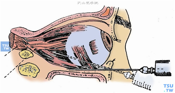 筋膜囊下（内）麻醉：点眼麻醉后，嘱向下注视，用镊子夹提结膜，在颞下方向直肌间筋膜囊内注射麻醉液2～3ml，亦能达到与球后麻醉同等效果