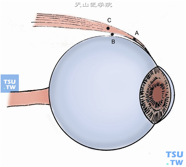 上下直肌牵引缝线：用斜视钩使眼球下转，在12点角膜缘后1cm处，用眼科无损伤镊夹持上直肌肌腱，用圆针3-0丝线，贯穿上直肌附着点稍后方肌腱与巩膜之间（B）或肌腱上（C），留置缝线作牵引用。下直肌缝线用有钩镊距6点角膜缘外7mm处，先闭合、后张开夹持下直肌腱，用圆针3-0丝线，贯穿其肌腱，留置缝合牵引线备用