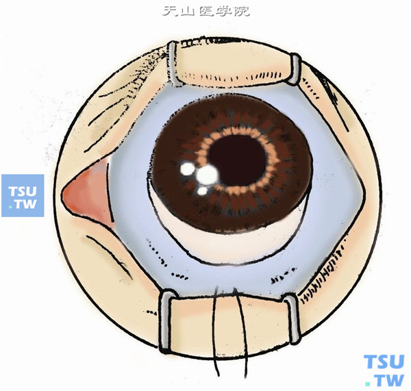 球后麻醉充分时，可免去结膜下浸润麻醉。以穹窿为基底，2～10点时钟位沿角巩膜缘120°剪开球结膜及其下组织，向上推开或少许分离。双极电凝或热灼巩膜表面止血，清晰暴露青灰色角巩膜缘部