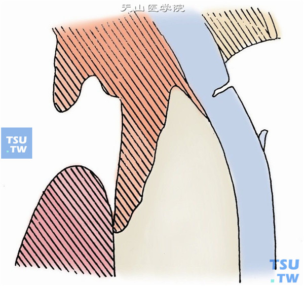第二面，切开角巩膜缘。在青灰色角巩膜缘后缘，作垂直于巩膜面120°，约1/2巩膜厚度的均匀性切开。其后，亦可予置缝线2～3针。切开长度可根据核的大小决定切口的长度