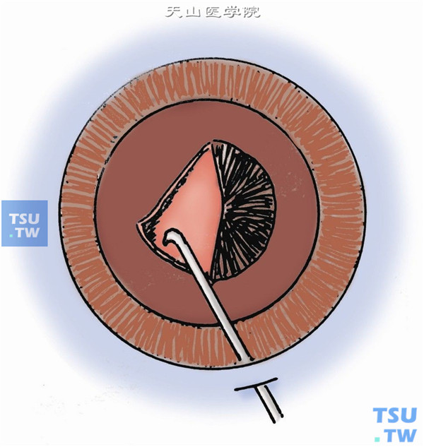 连续环形撕囊：在前囊膜上方11点或下方5点时钟位先作一小切口，用显微撕囊镊或截囊针翻转小切口处囊膜瓣作圆形撕囊，撕开的囊膜呈弧形方向牵引，连续撕开