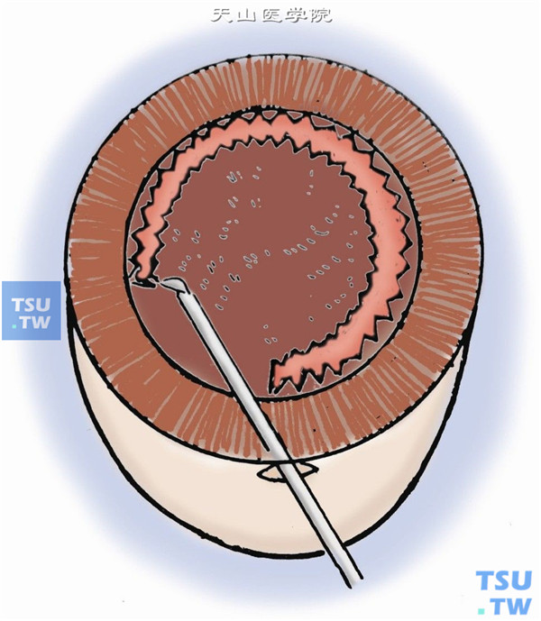 开罐式截囊：以切开创口为支点，离心或向心性密集点刺截开前囊。切开形状呈圆形。初学者或连续撕囊困难时多用此法