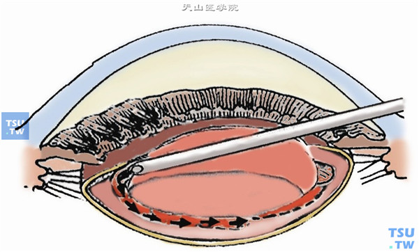 水分离、水分界。即囊与皮质分离及皮质与核分离。用眼内灌注液在前囊下一点或多点注入，分离前囊与皮质，成功分离时可见“金色反射环”；其后再作皮质与核分离