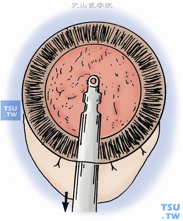皮质吸引。间断缝合暂时闭合创口，间距约3mm，用双管注吸针吸引皮质（亦可应用超声乳化I/A）。注意吸引孔必须朝上，边灌注边吸引，先吸引前房中漂浮的皮质，再吸引虹膜后面及位于赤道部的皮质、周边部的皮质，必须将皮质拉至瞳孔区，在直视下分次吸出。其顺序一般为：5点半—1点；6点—11点；11点—12点时钟位