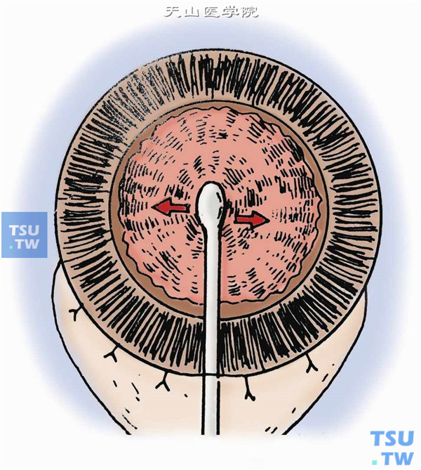 后囊抛光。以眼底红光反射为背景，用抛光器在保持前房的前提下，接触后囊（可见环形光晕），谨慎地做同心圆或左右往复运动，轻轻摩擦后囊抛光，除去微细的皮质纤维及上皮细胞