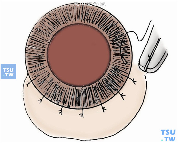 角巩膜缝合。一般用10-0尼龙线间断缝合4～6针，达到水密状态。缝针与创缘呈放射状，间距相等，线结可埋入创缘巩膜侧