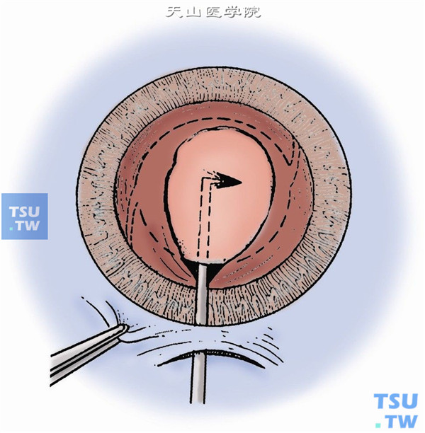 白内障手术示意图1