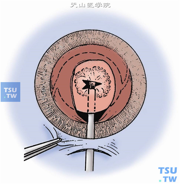 白内障手术示意图2