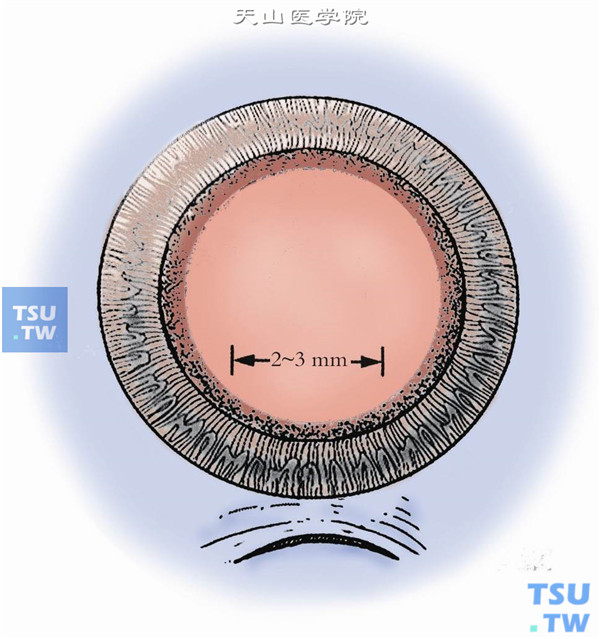 白内障手术示意图3